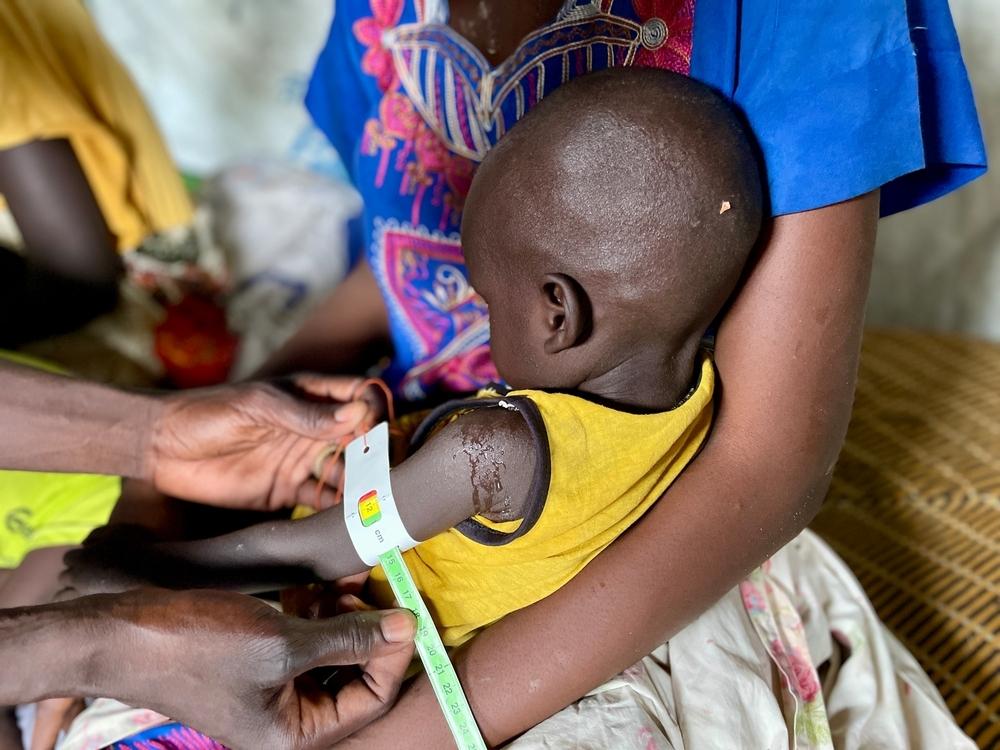 Un membre du personnel de MSF mesure la circonférence moyenne du bras (MUAC) de Zacharia Peter Dak, qui souffre de malnutrition sévère. Sa mère, Nyachangjwok William Oguen, est arrivée sur le site de protection des civils en avril dernier avec son frère. 2024 © Kristen Poels/MSF