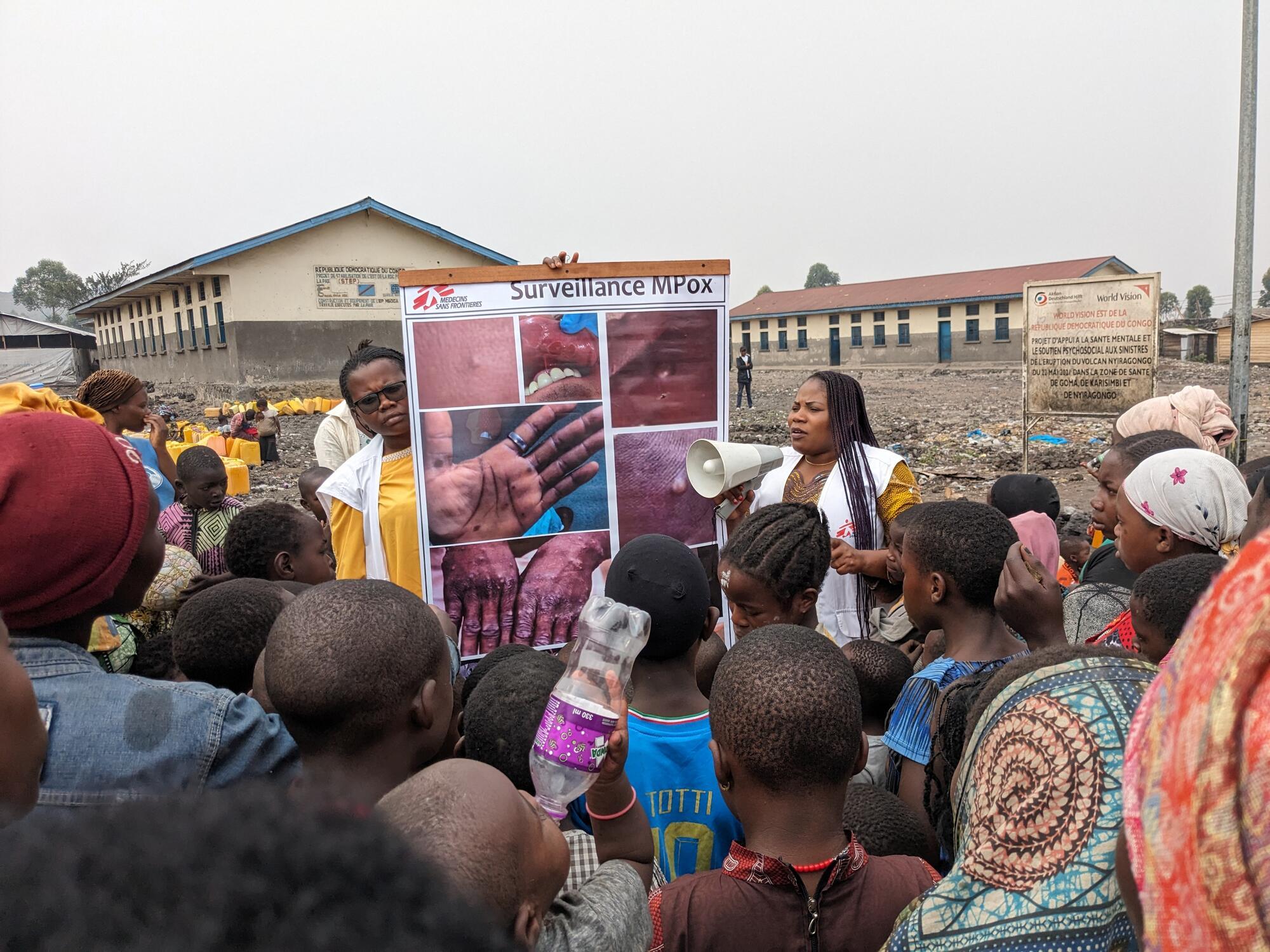 Cinq questions sur l’épidémie de Mpox en RDC 