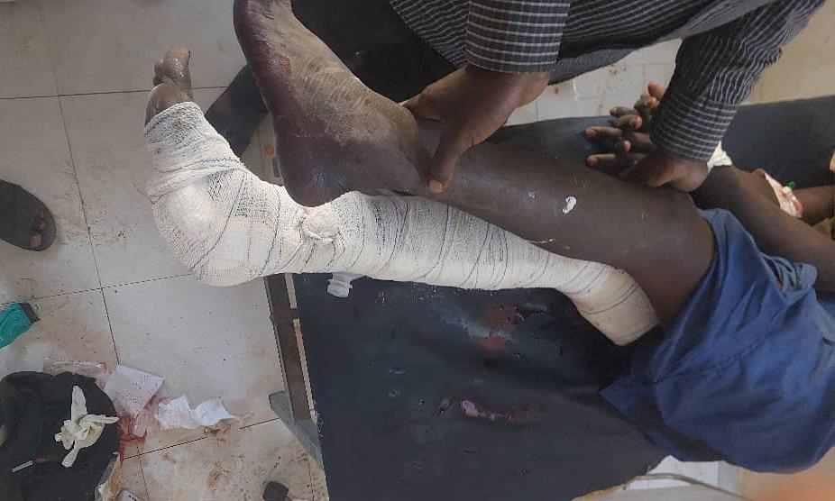 Un patient de l'hôpital universitaire de Nyala, soutenu par MSF, reçoit un traitement pour des blessures causées par des frappes aériennes le 3 février 2025.