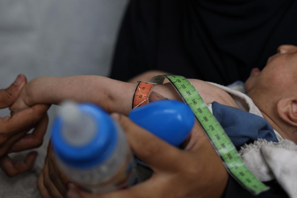 Un enfant palestinien souffrant de malnutrition subit un examen médical dans une clinique MSF de la ville de Gaza.