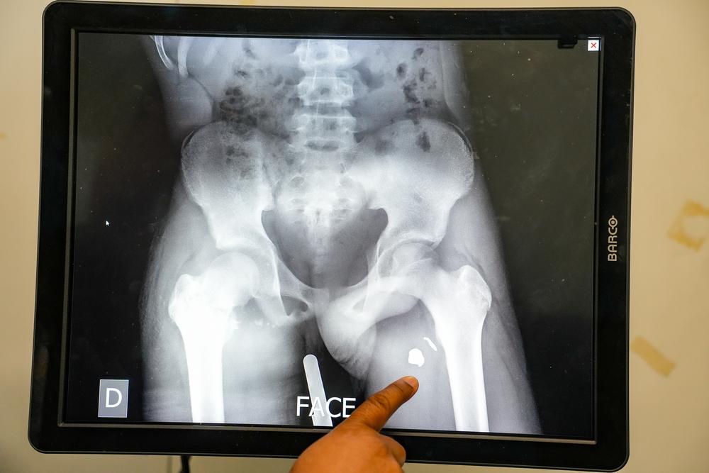 Une radiographie montrant des éclats d'obus logés dans le corps d'un patient à l'hôpital traumatologique de Tabarre, géré par MSF. Haïti. Janvier 2026  © Marx Stanley Léveillé/MSF