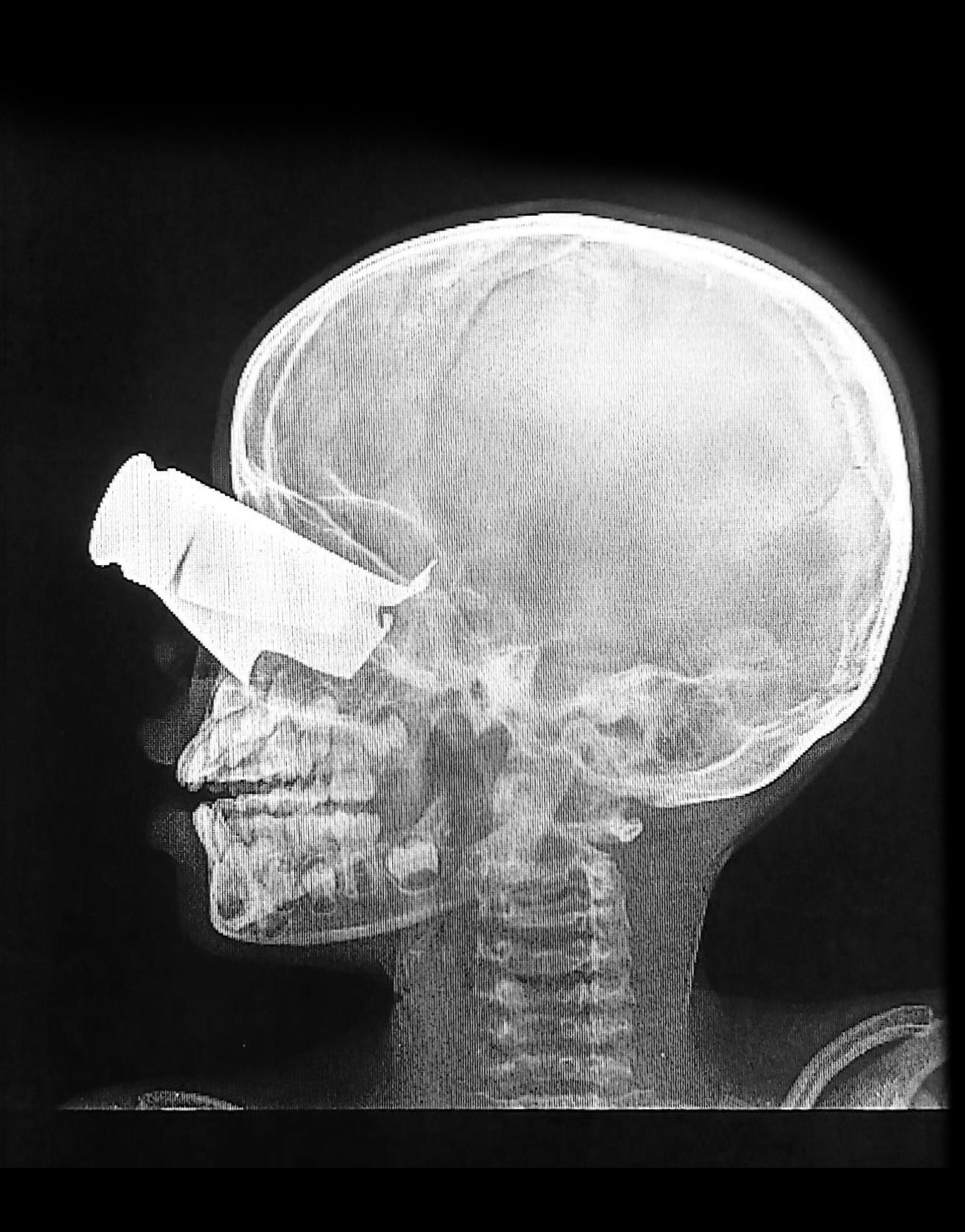 Scanner éclat d'obus sur le visage