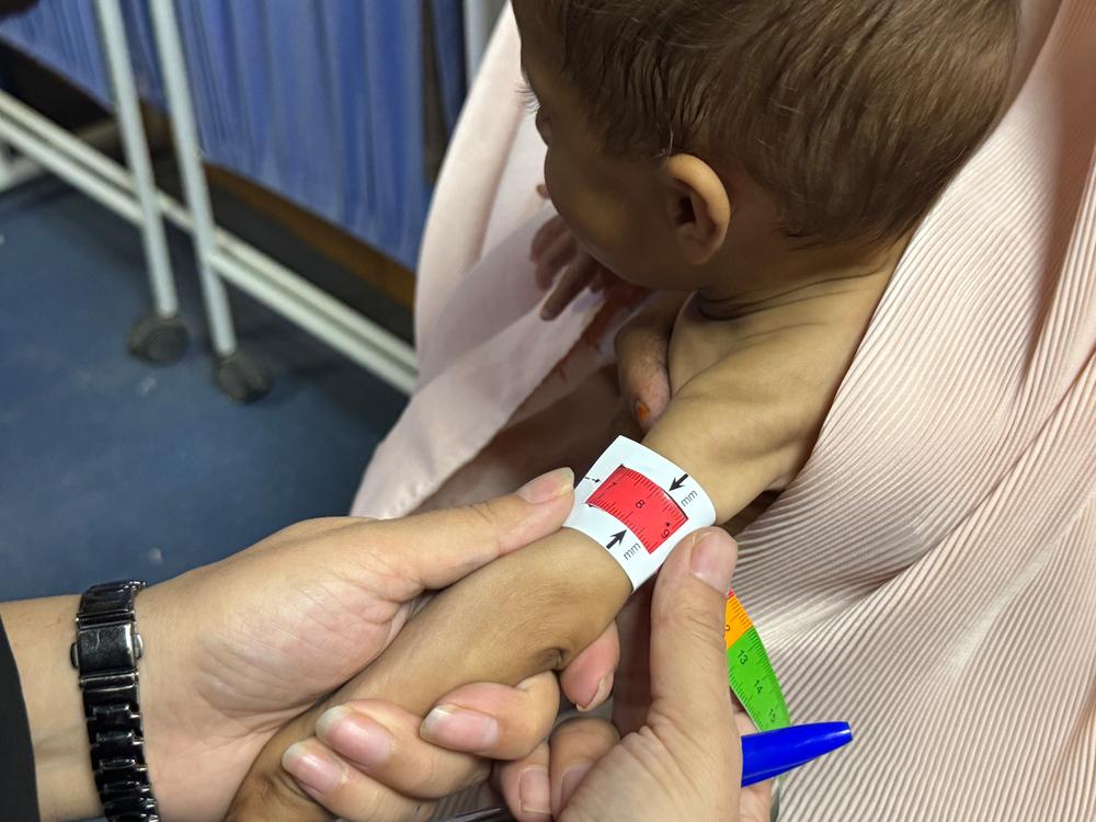 Une infirmière de MSF utilise un mètre ruban pour mesurer la circonférence du bras à mi-hauteur (MUAC) afin d’évaluer l’état d’un bébé lors d’un triage au centre de nutrition thérapeutique ambulatoire de MSF à Kandahar, dans le sud de l’Afghanistan. Avec une circonférence du bras à mi-hauteur inférieure à 11 centimètres, ce bébé souffre de malnutrition aiguë sévère et a besoin d’un traitement médical d’urgence. Kandahar, Afghanistan; mai 2026 © Nazia Kamal/MSF 