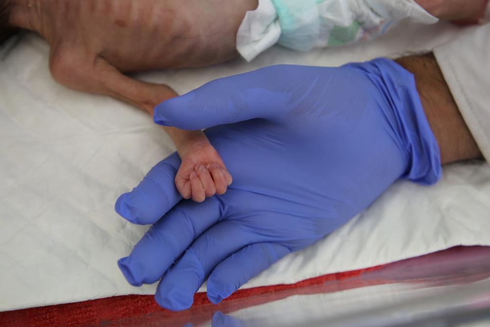 Un enfant souffrant de malnutrition sévère est admis dans le centre de nutrition thérapeutique pour patients hospitalisés (ITFC) soutenu par MSF à l&#039;hôpital Abs de Hajjah, au Yémen. 