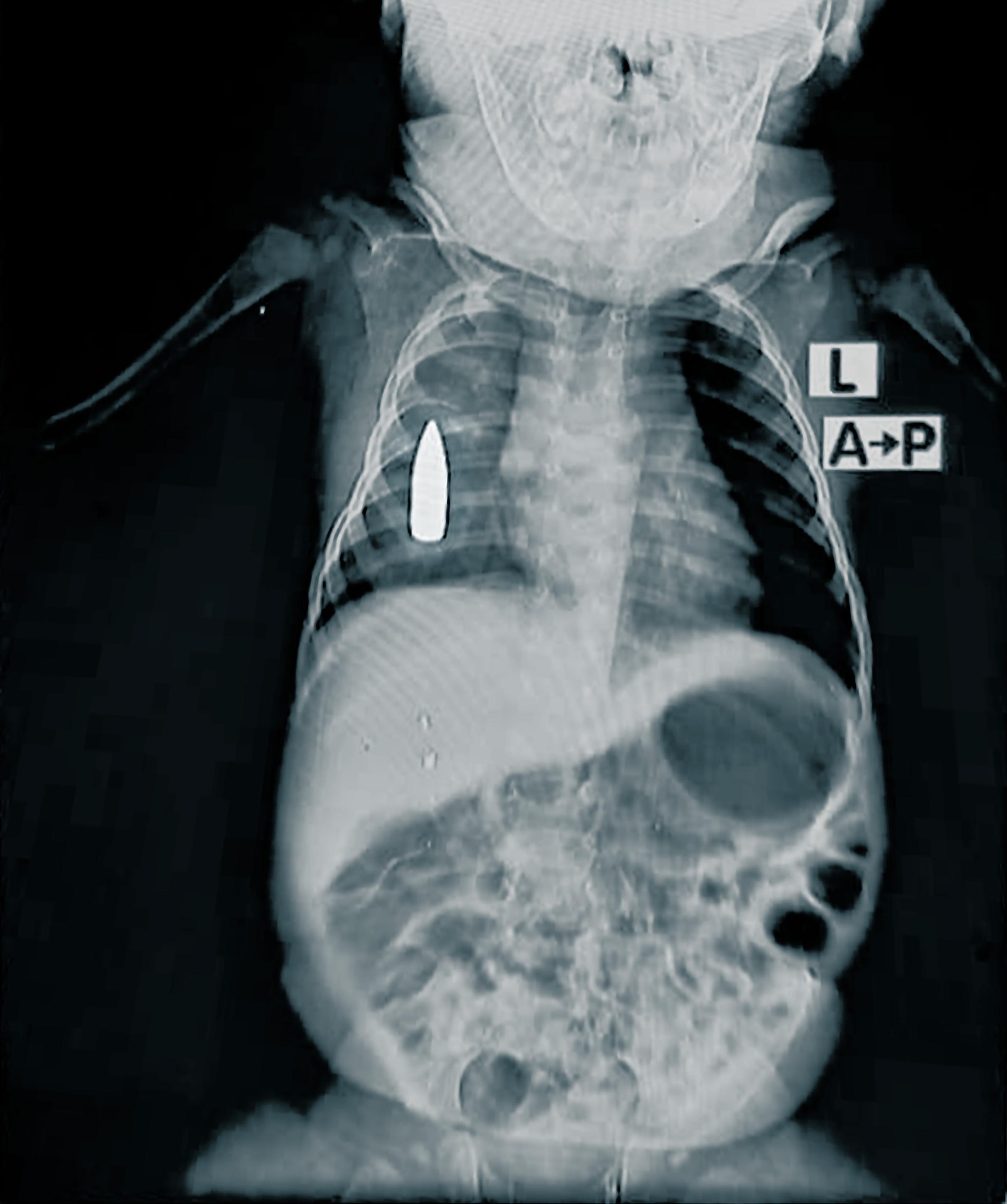 Radiographie du bébé Riyad. Le bébé de 18 mois a été touché à la poitrine par une balle perdue alors qu'il faisait une sieste à Khartoum.
