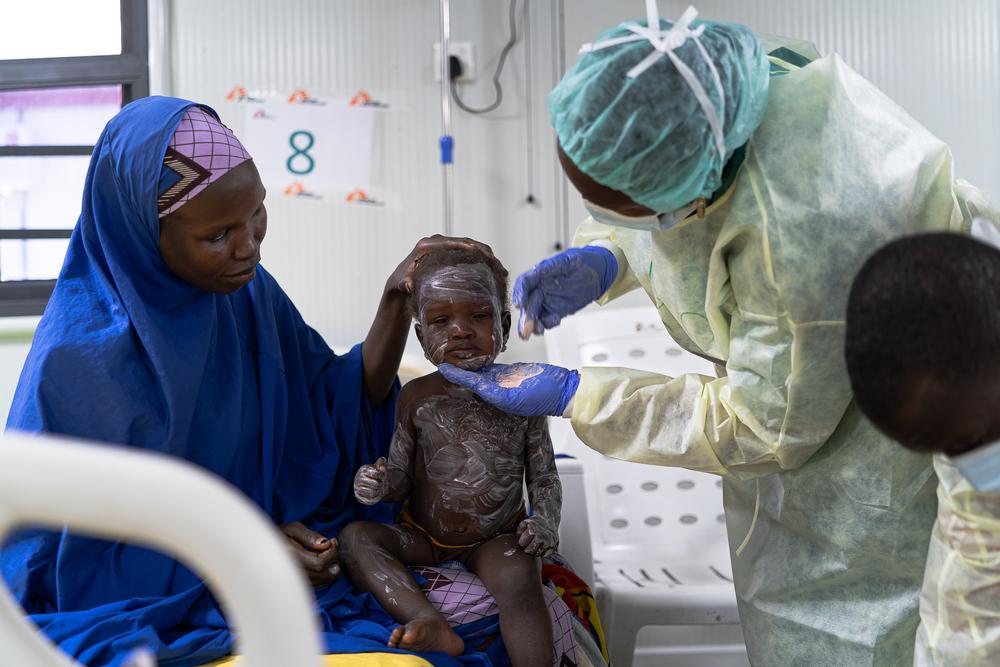 Measles-related admissions reach record at MSF facilities in Maiduguri