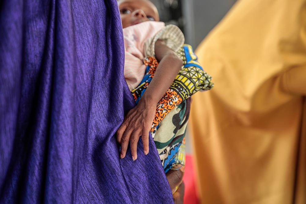 Le bras d&#039;un enfant souffrant de malnutrition aiguë sévère à Kofar Marusa ATFC, État de Katsina, Nigeria, juin 2022. 