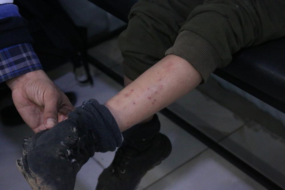 Scabies due to lack of water