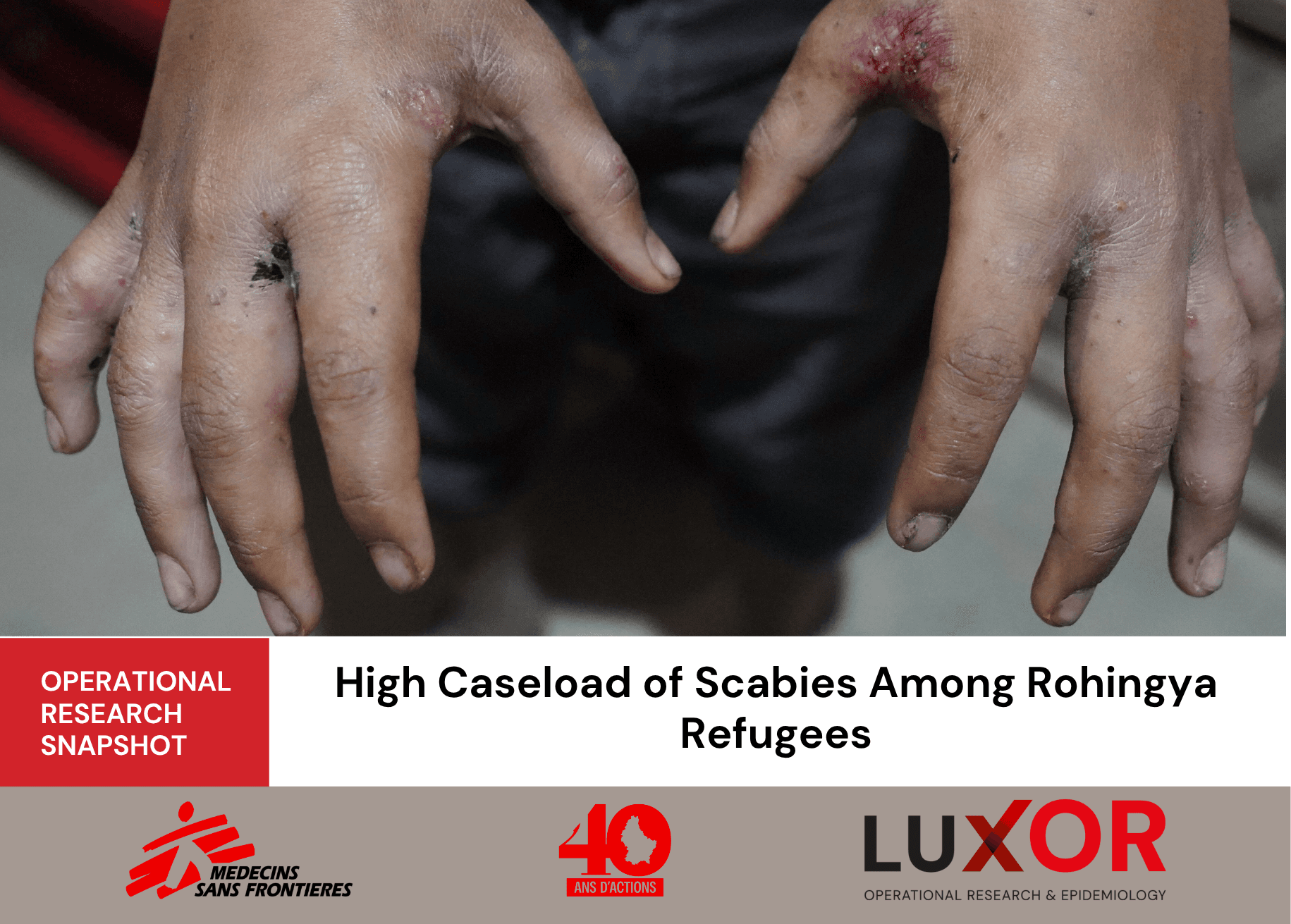 Scabies Among Rohingya Refugees