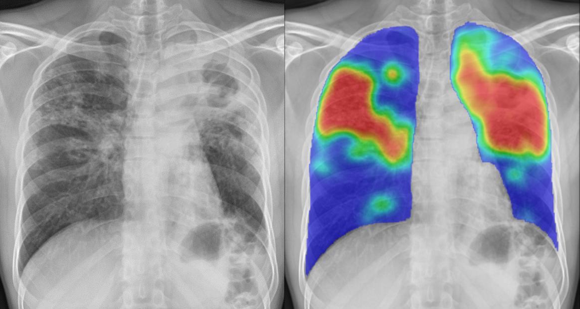 La radiographie thoracique montre un score CAD4TB très élevé (94). Les zones rouges/orange indiquent les régions que l'IA considère comme atteintes de tuberculose. Le diagnostic de tuberculose a été confirmé chez ce patient. République Centrafricaine.