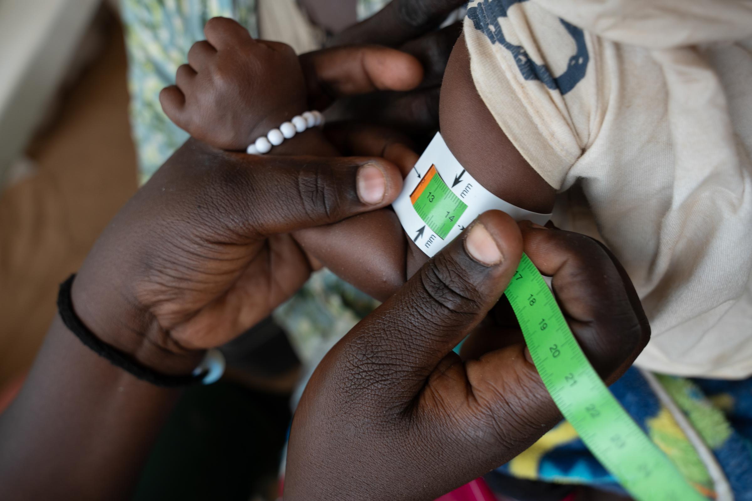 Dépistage de malnutrition sur un jeune enfant à l'aide d’une bandelette de mesure du périmètre brachial (MUAC)